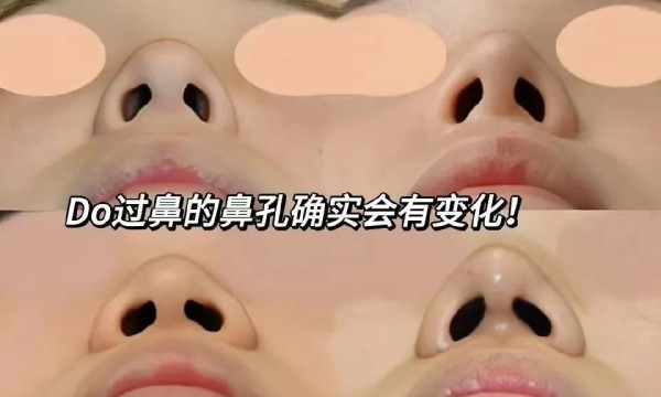 隆鼻攻略丨隆鼻手术多少钱