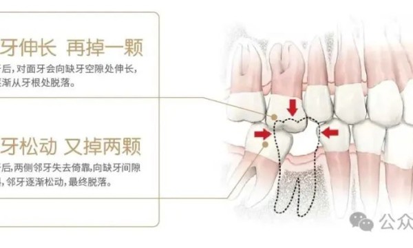 拔牙术后注意事项